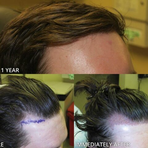 Before & After Photos | Chicago, IL | New Horizons Robotic Hair ...